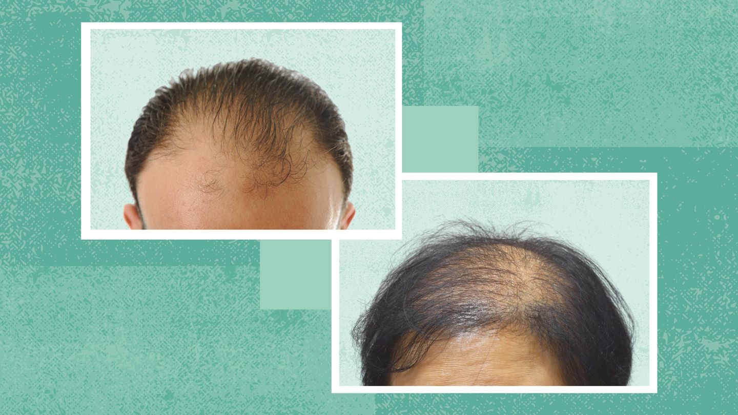 Male vs Female Hair Loss Patterns: Causes, Treatments & Coping With Hair Thinning