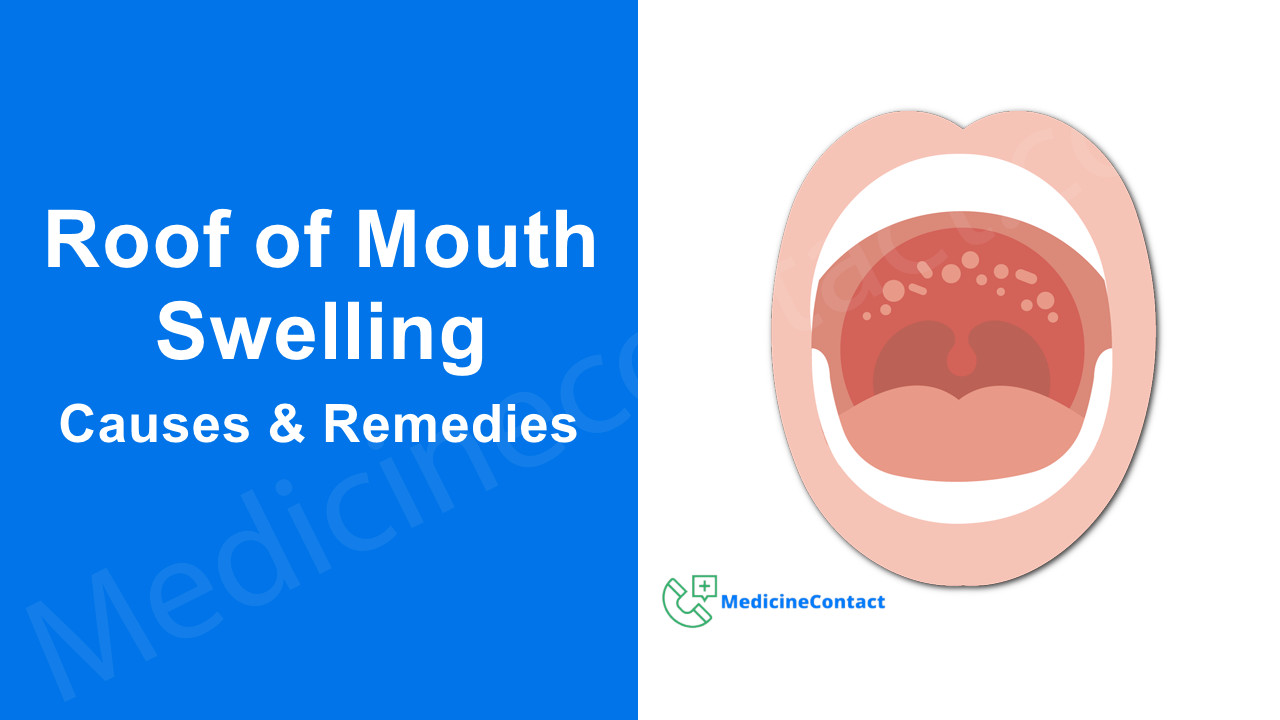 Roof of Mouth Swelling: 6 Causes and Remedies