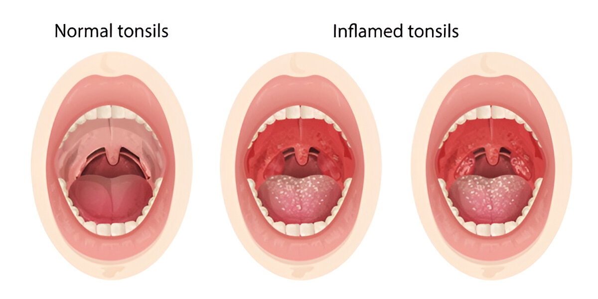 What Does a Healthy Throat Look Like?